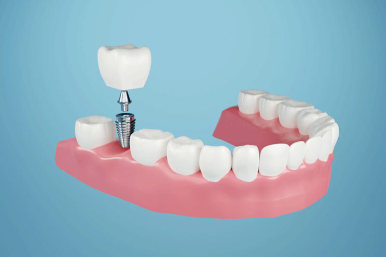 Dental implant, Fixing missing teeth with metal screw, teeth crown treatment 3D rendering.