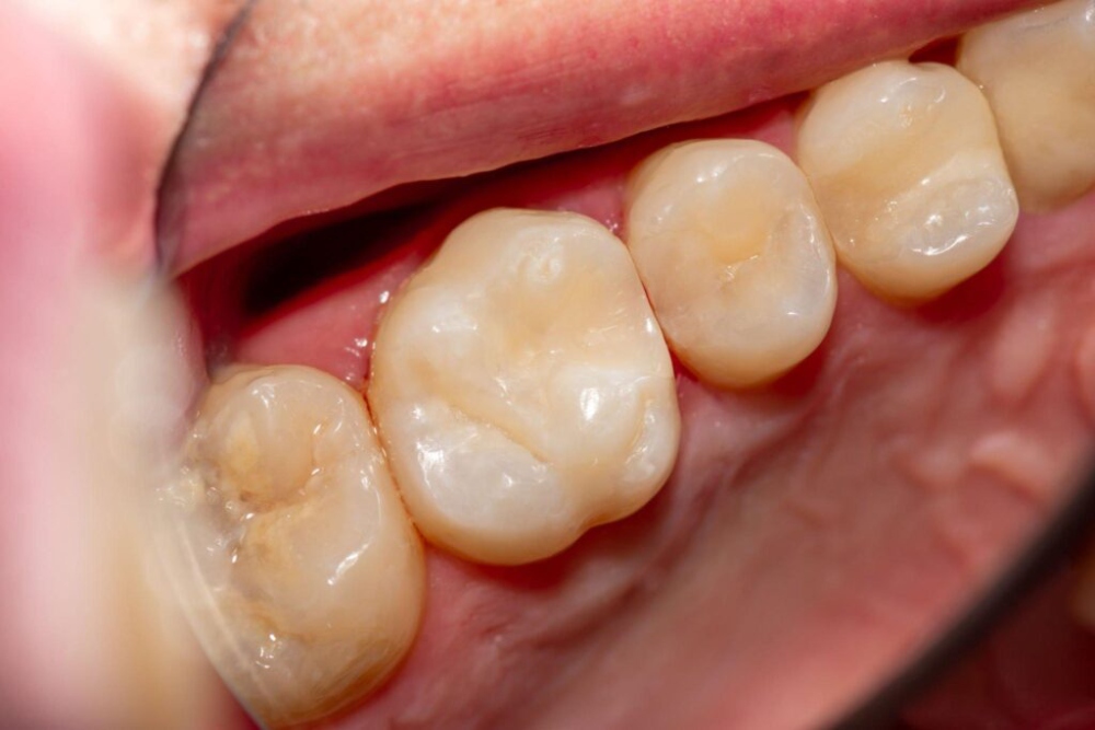 dental sealants last